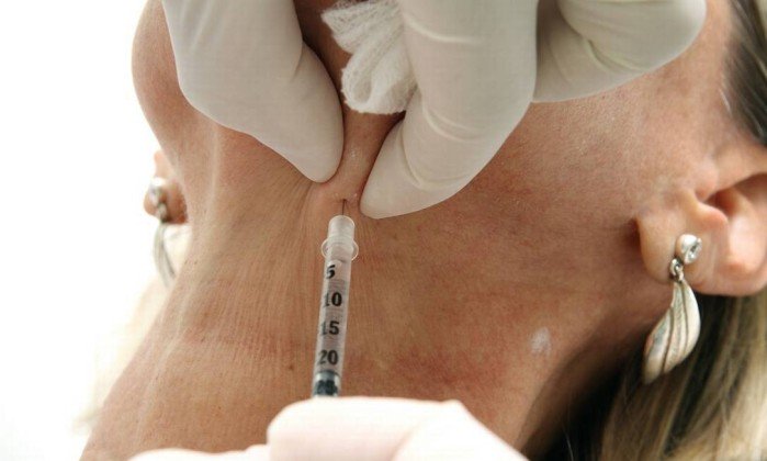 Dentistas entram com recurso contra liminar que os impede de aplicar botox para fins estéticos