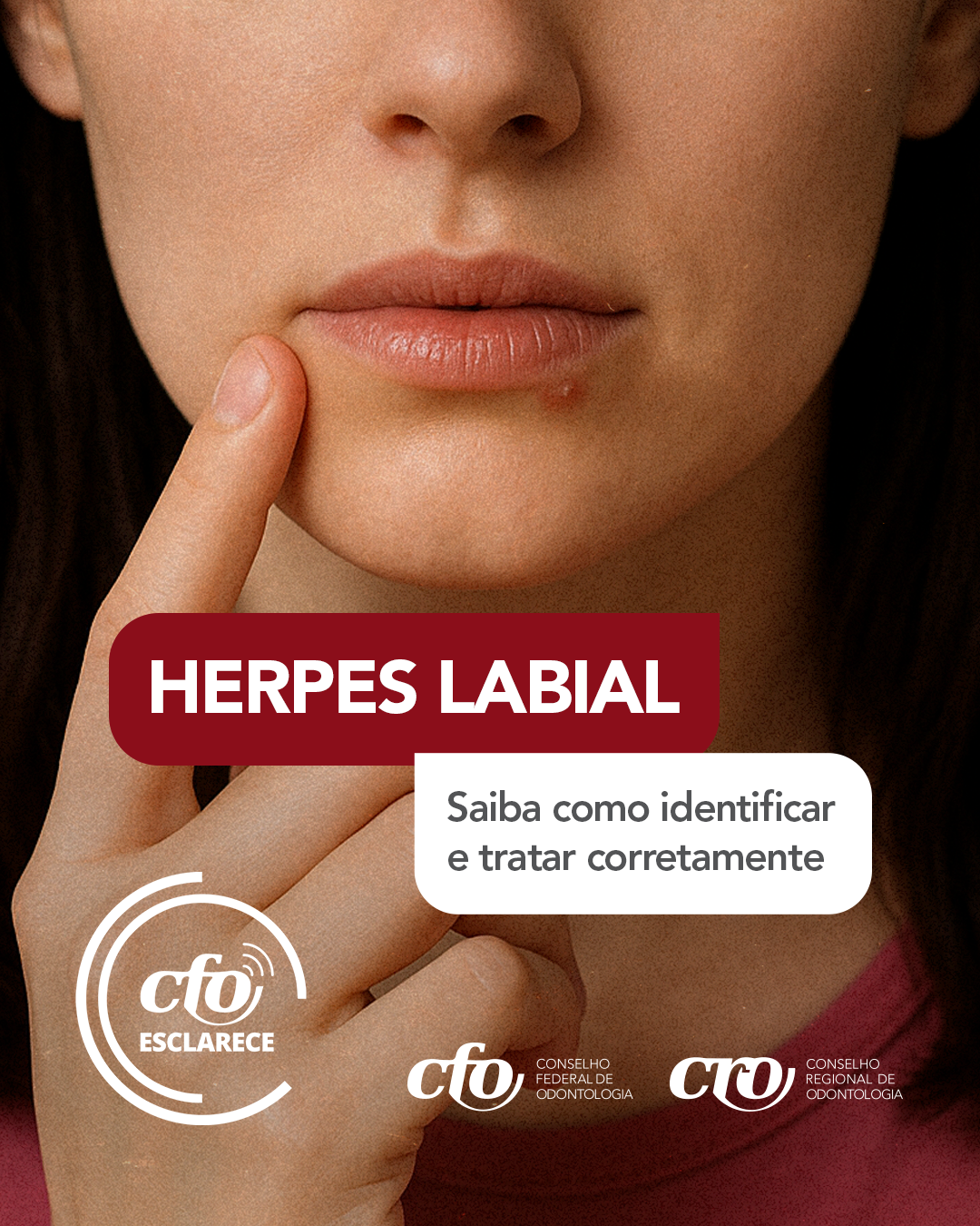 Herpes labial e o papel do cirurgião-dentista